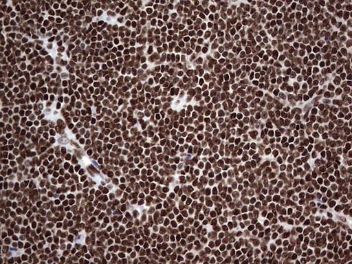 HNRNPL / hnRNP L Antibody - IHC of paraffin-embedded Human lymphoma tissue using anti-HNRNPL mouse monoclonal antibody. (Heat-induced epitope retrieval by 1 mM EDTA in 10mM Tris, pH8.5, 120°C for 3min).