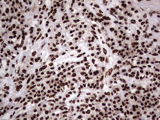 HNRNPL / hnRNP L Antibody - Immunohistochemical staining of paraffin-embedded Carcinoma of Human lung tissue using anti-HNRNPL mouse monoclonal antibody. (Heat-induced epitope retrieval by 1 mM EDTA in 10mM Tris, pH8.5, 120C for 3min,