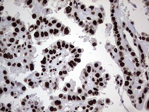 HNRNPL / hnRNP L Antibody - Immunohistochemical staining of paraffin-embedded Adenocarcinoma of Human ovary tissue using anti-HNRNPL mouse monoclonal antibody. (Heat-induced epitope retrieval by 1 mM EDTA in 10mM Tris, pH8.5, 120C for 3min,