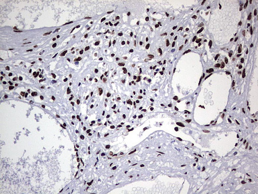 HNRNPL / hnRNP L Antibody - Immunohistochemical staining of paraffin-embedded Human thyroid tissue within the normal limits using anti-HNRNPL mouse monoclonal antibody. (Heat-induced epitope retrieval by 1 mM EDTA in 10mM Tris, pH8.5, 120C for 3min,