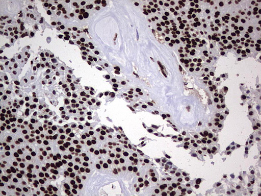 HNRNPL / hnRNP L Antibody - Immunohistochemical staining of paraffin-embedded Carcinoma of Human thyroid tissue using anti-HNRNPL mouse monoclonal antibody. (Heat-induced epitope retrieval by 1 mM EDTA in 10mM Tris, pH8.5, 120C for 3min,