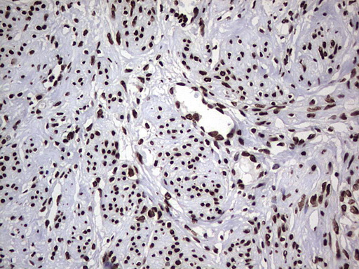 HNRNPL / hnRNP L Antibody - Immunohistochemical staining of paraffin-embedded Human endometrium tissue within the normal limits using anti-HNRNPL mouse monoclonal antibody. (Heat-induced epitope retrieval by 1 mM EDTA in 10mM Tris, pH8.5, 120C for 3min,