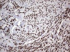 HNRNPL / hnRNP L Antibody - Immunohistochemical staining of paraffin-embedded Adenocarcinoma of Human endometrium tissue using anti-HNRNPL mouse monoclonal antibody. (Heat-induced epitope retrieval by 1 mM EDTA in 10mM Tris, pH8.5, 120C for 3min,