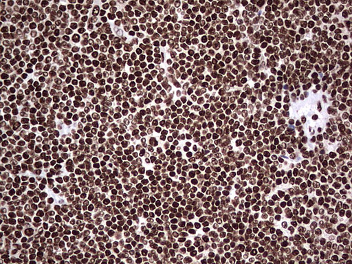 HNRNPL / hnRNP L Antibody - Immunohistochemical staining of paraffin-embedded Human lymphoma tissue using anti-HNRNPL mouse monoclonal antibody. (Heat-induced epitope retrieval by 1 mM EDTA in 10mM Tris, pH8.5, 120C for 3min,
