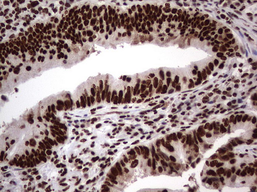 HNRNPL / hnRNP L Antibody - Immunohistochemical staining of paraffin-embedded Adenocarcinoma of Human colon tissue using anti-HNRNPL mouse monoclonal antibody. (Heat-induced epitope retrieval by 1 mM EDTA in 10mM Tris, pH8.5, 120C for 3min,
