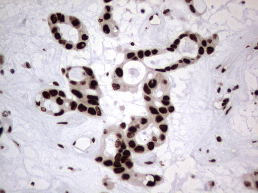 HNRNPL / hnRNP L Antibody - Immunohistochemical staining of paraffin-embedded Carcinoma of Human liver tissue using anti-HNRNPL mouse monoclonal antibody. (Heat-induced epitope retrieval by 1 mM EDTA in 10mM Tris, pH8.5, 120C for 3min,