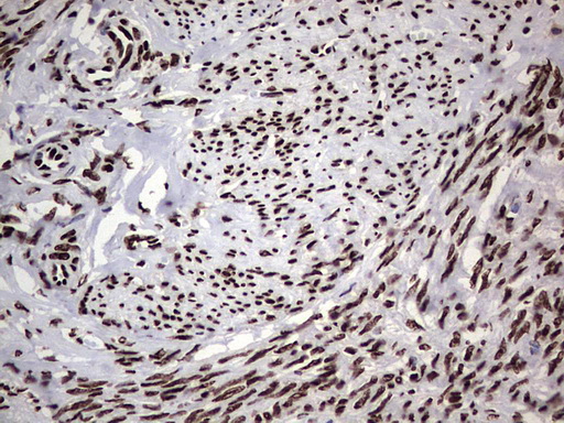 HNRNPL / hnRNP L Antibody - IHC of paraffin-embedded Adenocarcinoma of Human endometrium tissue using anti-HNRNPL mouse monoclonal antibody. (Heat-induced epitope retrieval by 1 mM EDTA in 10mM Tris, pH8.5, 120°C for 3min).