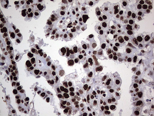 HNRNPL / hnRNP L Antibody - Immunohistochemical staining of paraffin-embedded Adenocarcinoma of Human ovary tissue using anti-HNRNPL mouse monoclonal antibody. (Heat-induced epitope retrieval by 1 mM EDTA in 10mM Tris, pH8.5, 120C for 3min,