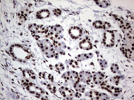 HNRNPL / hnRNP L Antibody - Immunohistochemical staining of paraffin-embedded Carcinoma of Human pancreas tissue using anti-HNRNPL mouse monoclonal antibody. (Heat-induced epitope retrieval by 1 mM EDTA in 10mM Tris, pH8.5, 120C for 3min,