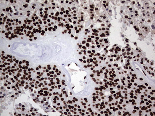 HNRNPL / hnRNP L Antibody - Immunohistochemical staining of paraffin-embedded Carcinoma of Human thyroid tissue using anti-HNRNPL mouse monoclonal antibody. (Heat-induced epitope retrieval by 1 mM EDTA in 10mM Tris, pH8.5, 120C for 3min,