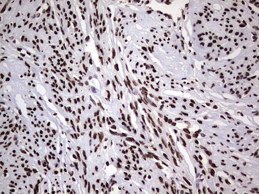 HNRNPL / hnRNP L Antibody - Immunohistochemical staining of paraffin-embedded Human endometrium tissue within the normal limits using anti-HNRNPL mouse monoclonal antibody. (Heat-induced epitope retrieval by 1 mM EDTA in 10mM Tris, pH8.5, 120C for 3min,