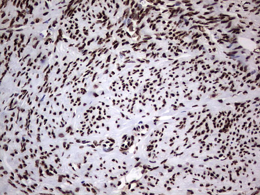 HNRNPL / hnRNP L Antibody - Immunohistochemical staining of paraffin-embedded Adenocarcinoma of Human endometrium tissue using anti-HNRNPL mouse monoclonal antibody. (Heat-induced epitope retrieval by 1 mM EDTA in 10mM Tris, pH8.5, 120C for 3min,