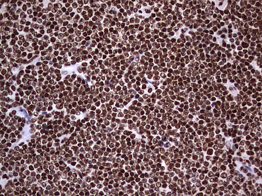 HNRNPL / hnRNP L Antibody - Immunohistochemical staining of paraffin-embedded Human lymphoma tissue using anti-HNRNPL mouse monoclonal antibody. (Heat-induced epitope retrieval by 1 mM EDTA in 10mM Tris, pH8.5, 120C for 3min,