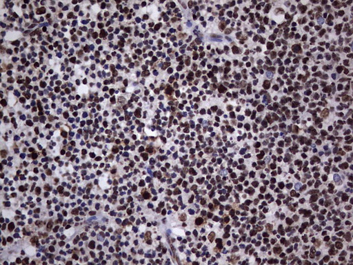 HNRNPL / hnRNP L Antibody - Immunohistochemical staining of paraffin-embedded Human tonsil within the normal limits using anti-HNRNPL mouse monoclonal antibody. (Heat-induced epitope retrieval by 1 mM EDTA in 10mM Tris, pH8.5, 120C for 3min,