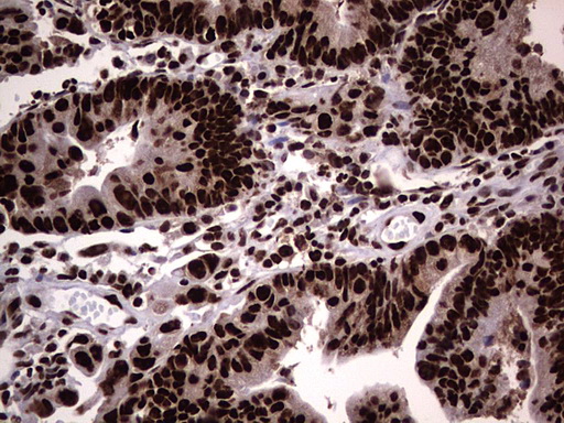 HNRNPL / hnRNP L Antibody - Immunohistochemical staining of paraffin-embedded Adenocarcinoma of Human colon tissue using anti-HNRNPL mouse monoclonal antibody. (Heat-induced epitope retrieval by 1 mM EDTA in 10mM Tris, pH8.5, 120C for 3min,