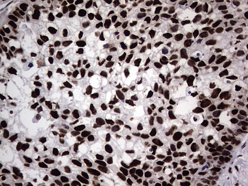 HNRNPL / hnRNP L Antibody - Immunohistochemical staining of paraffin-embedded Carcinoma of Human kidney tissue using anti-HNRNPL mouse monoclonal antibody. (Heat-induced epitope retrieval by 1 mM EDTA in 10mM Tris, pH8.5, 120C for 3min,