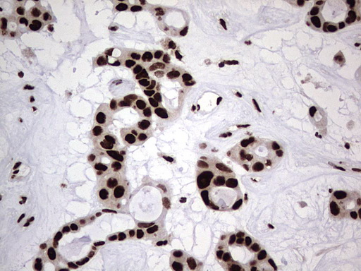 HNRNPL / hnRNP L Antibody - Immunohistochemical staining of paraffin-embedded Carcinoma of Human liver tissue using anti-HNRNPL mouse monoclonal antibody. (Heat-induced epitope retrieval by 1 mM EDTA in 10mM Tris, pH8.5, 120C for 3min,