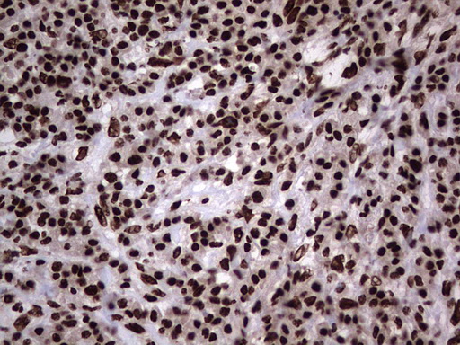 HNRNPL / hnRNP L Antibody - IHC of paraffin-embedded Carcinoma of Human lung tissue using anti-HNRNPL mouse monoclonal antibody. (Heat-induced epitope retrieval by 1 mM EDTA in 10mM Tris, pH8.5, 120°C for 3min).