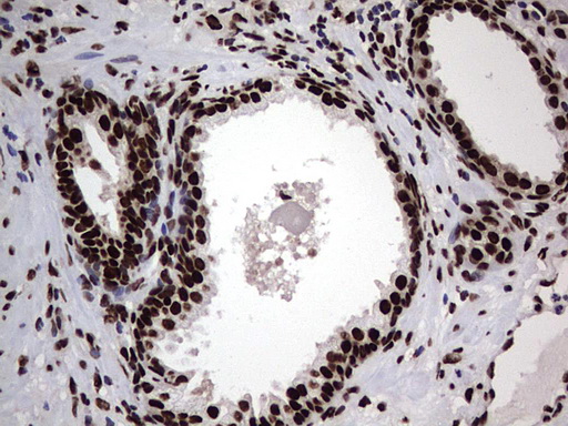 HNRNPL / hnRNP L Antibody - IHC of paraffin-embedded Carcinoma of Human prostate tissue using anti-HNRNPL mouse monoclonal antibody. (Heat-induced epitope retrieval by 1 mM EDTA in 10mM Tris, pH8.5, 120°C for 3min).