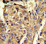 HNRNPL / hnRNP L Antibody - Formalin-fixed and paraffin-embedded human hepatocarcinoma reacted with HNRPL Antibody , which was peroxidase-conjugated to the secondary antibody, followed by DAB staining. This data demonstrates the use of this antibody for immunohistochemistry; clinical relevance has not been evaluated.