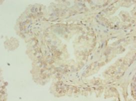 HNRNPL / hnRNP L Antibody - Immunohistochemistry of paraffin-embedded human prostate cancer using antibody at 1:100 dilution.  This image was taken for the unconjugated form of this product. Other forms have not been tested.