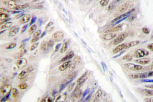 HNRNPL / hnRNP L Antibody - IHC of hnRNP L (G58) pAb in paraffin-embedded human colon carcinoma tissue.