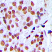 HNRNPL / hnRNP L Antibody - Immunohistochemical analysis of hnRNP L staining in human breast cancer formalin fixed paraffin embedded tissue section. The section was pre-treated using heat mediated antigen retrieval with sodium citrate buffer (pH 6.0). The section was then incubated with the antibody at room temperature and detected using an HRP polymer system. DAB was used as the chromogen. The section was then counterstained with hematoxylin and mounted with DPX.