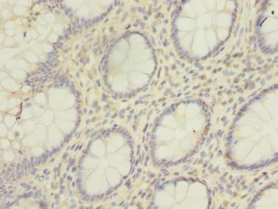 HNRNPL / hnRNP L Antibody - Immunohistochemistry of paraffin-embedded human colon cancer using antibody at dilution of 1:100.