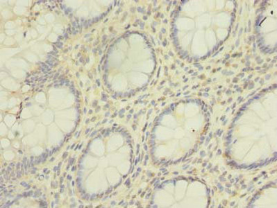 HNRNPL / hnRNP L Antibody - Immunohistochemistry of paraffin-embedded human colon cancer using HNRNPL Antibody at dilution of 1:100