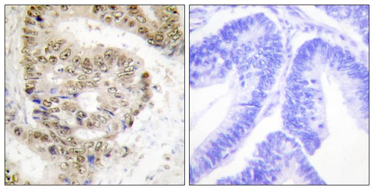 HNRNPL / hnRNP L Antibody - Peptide - + Immunohistochemistry analysis of paraffin-embedded human colon carcinoma tissue using hnRNP L antibody.