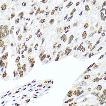 HNRNPR / hnRNP R Antibody - Immunohistochemistry of paraffin-embedded human prostate cancer tissue.
