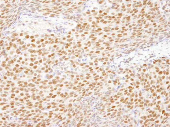 HNRNPUL1 Antibody - Detection of Human E1B-AP5 by Immunohistochemistry. Sample: FFPE section of human breast carcinoma. Antibody: Affinity purified rabbit anti-E1B-AP5 used at a dilution of 1:100.