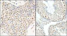 HNRNPUL1 Antibody - Detection of Human and Mouse E1B-AP5 by Immunohistochemistry. Sample: FFPE section of human small cell lung cancer (left) and mouse testis (right). Antibody: Affinity purified rabbit anti-E1B-AP5 used at a dilution of 1:200 (1 Detection: DAB.