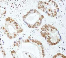 HNRNPUL1 Antibody - Detection of Human E1B-AP5 by Immunohistochemistry. Sample: FFPE section of human prostate carcinoma. Antibody: Affinity purified rabbit anti-E1B-AP5 used at a dilution of 1:200 (1 Detection: DAB.