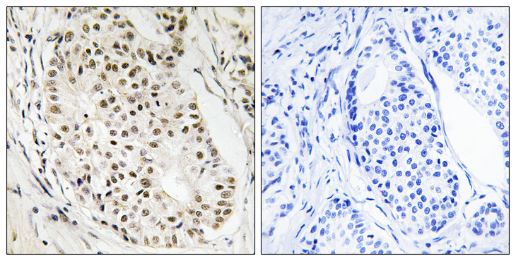 HNRNPUL2 Antibody - Immunohistochemistry analysis of paraffin-embedded human breast carcinoma tissue, using HNRNPUL2 Antibody. The picture on the right is blocked with the synthesized peptide.