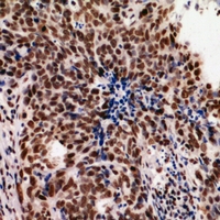 HNRNPUL2 Antibody - Immunohistochemical analysis of hnRNP UL2 staining in human breast cancer formalin fixed paraffin embedded tissue section. The section was pre-treated using heat mediated antigen retrieval with sodium citrate buffer (pH 6.0). The section was then incubated with the antibody at room temperature and detected using an HRP conjugated compact polymer system. DAB was used as the chromogen. The section was then counterstained with haematoxylin and mounted with DPX.