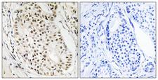 HNRNPUL2 Antibody - Peptide - + Immunohistochemistry analysis of paraffin-embedded human breast carcinoma tissue using HNRNPUL2 antibody.