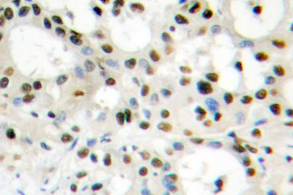 HNRPA1 / HnRNP A1 Antibody - IHC of hnRNP A1 (E85) pAb in paraffin-embedded human liver carcinoma tissue.
