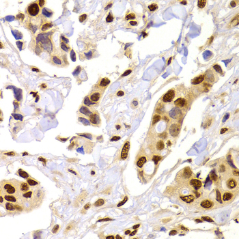 HNRPA1 / HnRNP A1 Antibody - Immunohistochemistry of paraffin-embedded human mammary cancer tissue.