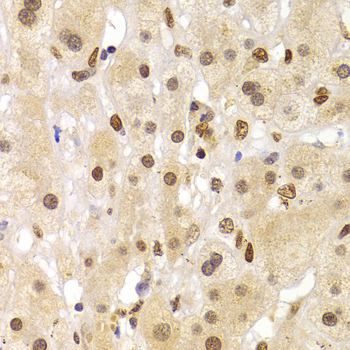 HNRPA1 / HnRNP A1 Antibody - Immunohistochemistry of paraffin-embedded human liver cancer tissue.
