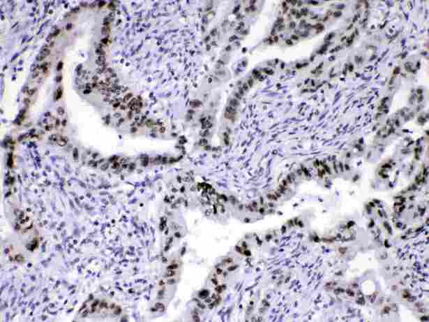 HNRPA1 / HnRNP A1 Antibody - HnRNP A1 was detected in paraffin-embedded sections of human intestinal cancer tissues using rabbit anti- HnRNP A1 Antigen Affinity purified polyclonal antibody