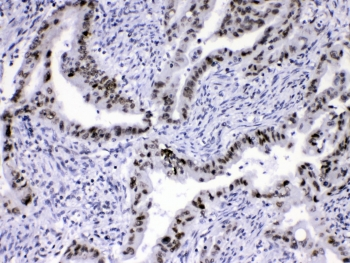 HNRPA1 / HnRNP A1 Antibody - IHC testing of human intestinal cancer with hnRNP A1 antibody at 1ug/ml. HIER: steam section in pH6 citrate buffer for 20 min.