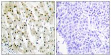 HNRPA1 / HnRNP A1 Antibody - Peptide - + Immunohistochemistry analysis of paraffin-embedded human liver carcinoma tissue using hnRNP A1 antibody.