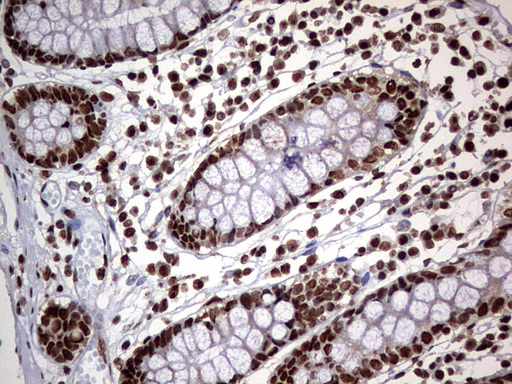 HNRPM / HNRNPM Antibody - IHC of paraffin-embedded Human colon tissue using anti-HNRNPM mouse monoclonal antibody. (Heat-induced epitope retrieval by 1 mM EDTA in 10mM Tris, pH9.0, 120°C for 3min).