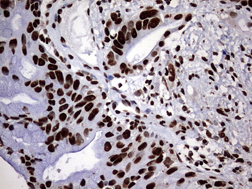 HNRPM / HNRNPM Antibody - IHC of paraffin-embedded Carcinoma of Human pancreas tissue using anti-HNRNPM mouse monoclonal antibody. (Heat-induced epitope retrieval by 1 mM EDTA in 10mM Tris, pH9.0, 120°C for 3min).