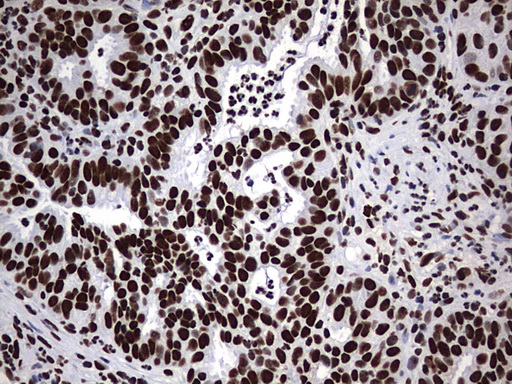 HNRPM / HNRNPM Antibody - IHC of paraffin-embedded Human lymph node tissue using anti-HNRNPM mouse monoclonal antibody. (Heat-induced epitope retrieval by 1 mM EDTA in 10mM Tris, pH9.0, 120°C for 3min).