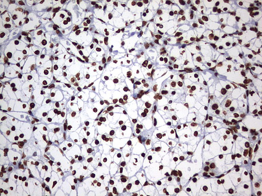 HNRPM / HNRNPM Antibody - IHC of paraffin-embedded Carcinoma of Human kidney tissue using anti-HNRNPM mouse monoclonal antibody. (Heat-induced epitope retrieval by 1 mM EDTA in 10mM Tris, pH9.0, 120°C for 3min).