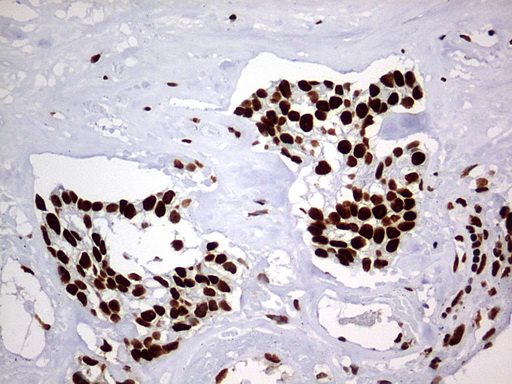 HNRPM / HNRNPM Antibody - IHC of paraffin-embedded Adenocarcinoma of Human breast tissue using anti-HNRNPM mouse monoclonal antibody. (Heat-induced epitope retrieval by 1 mM EDTA in 10mM Tris, pH9.0, 120°C for 3min).