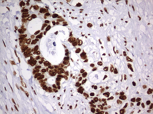 HNRPM / HNRNPM Antibody - IHC of paraffin-embedded Adenocarcinoma of Human colon tissue using anti-HNRNPM mouse monoclonal antibody. (Heat-induced epitope retrieval by 1 mM EDTA in 10mM Tris, pH9.0, 120°C for 3min).
