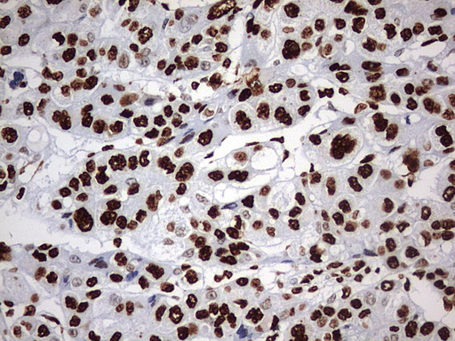 HNRPM / HNRNPM Antibody - IHC of paraffin-embedded Carcinoma of Human liver tissue using anti-HNRNPM mouse monoclonal antibody. (Heat-induced epitope retrieval by 1 mM EDTA in 10mM Tris, pH9.0, 120°C for 3min).